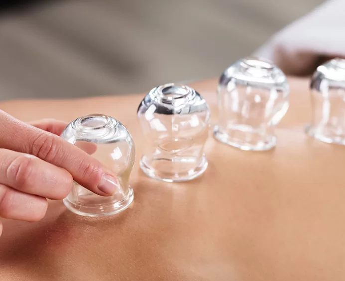 cupping-northcentral-indiana-sports-medicine-center-Logansport-IN